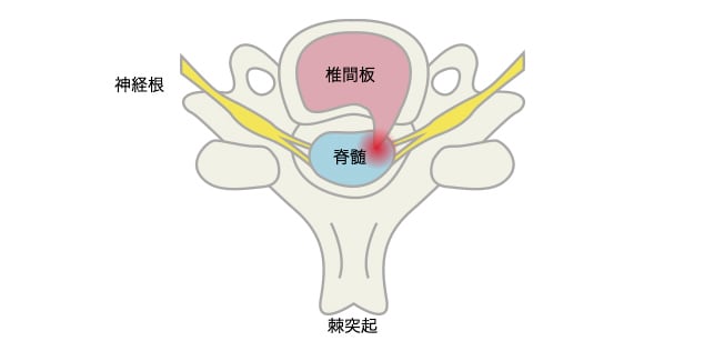脊髄症型の画像所見